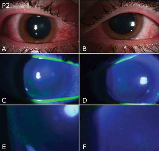 virus-killing-uv-lamps-are-burning-people-s-eyes-doctors-warn