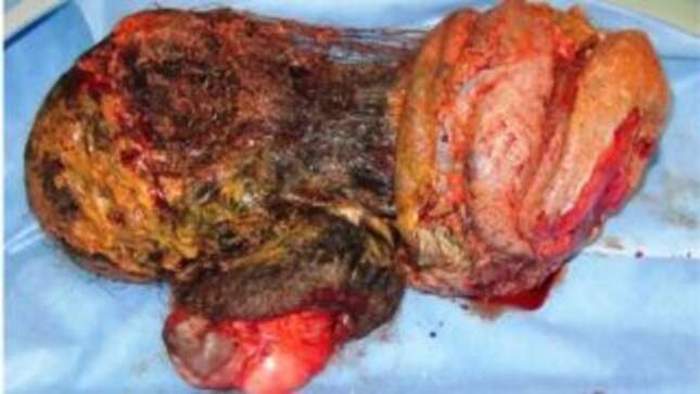 El “gemelo” de la chica.
Foto: Kumar, et al (BMJ Case Reports)