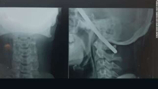 Imagen para el artículo titulado Sobrevive milagrosamente después de que una barra de hierro le atravesara el cráneo de lado a lado