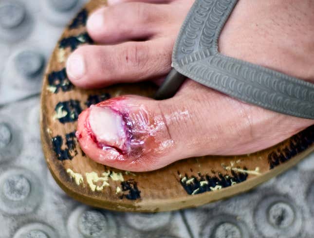 Image for article titled Long Wait For Big Toenail To Fall Off Nearly Over