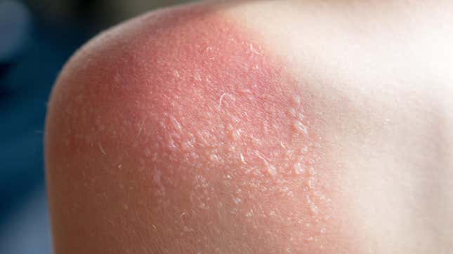 Image for article titled Stop Popping Your Sunburn Blisters