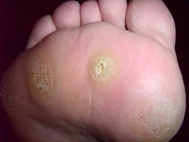 A more severe case of plantar warts. 