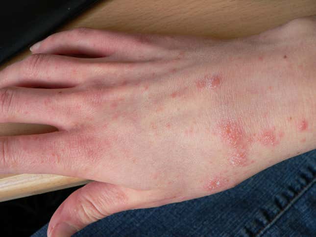A person’s right hand, wrist, and arm six days into their symptoms of scabies.