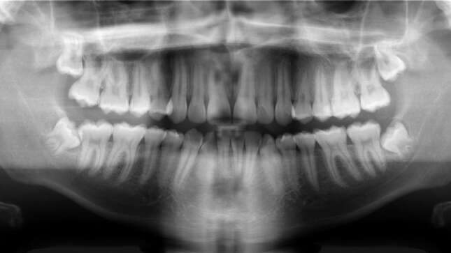 Imagen para el artículo titulado Un niño de 7 años acude al hospital con la mandíbula inflamada. Le extraen más de 500 dientes de la boca