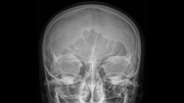 Imagen para el artículo titulado Este hombre llevó un globo lleno de marihuana en su nariz durante 18 años sin saberlo