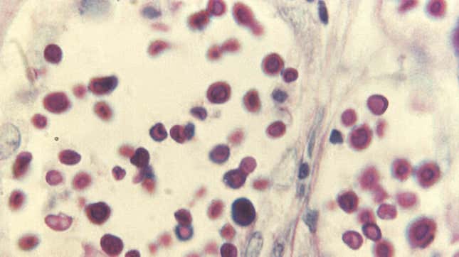 A photomicrograph of liver tissue infected by Cryptococcus.