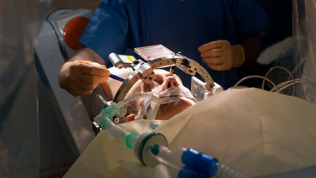 Stereotactic Neurosurgery operation, Pasteur 2 Hospital, Nice, France. A patient with Parkinsons disease is being treated with deep brain stimulation by implanting electrodes in brain and modulating cerebral electrical activity.