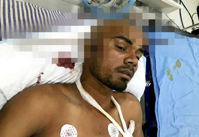 Imagen para el artículo titulado Sobrevive milagrosamente después de que una barra de hierro le atravesara el cráneo de lado a lado