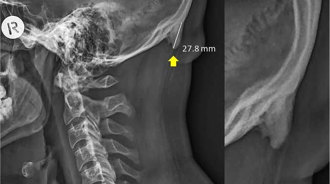 No, Using a Cellphone Isn't Causing You to Grow a Horn