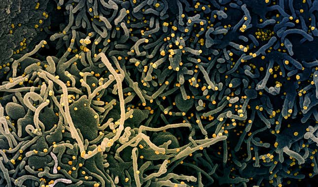 Células de un paciente de covid-19 con síntomas de apoptosis y elongamiento tras ser infectadas por el SARS-CoV-2.
