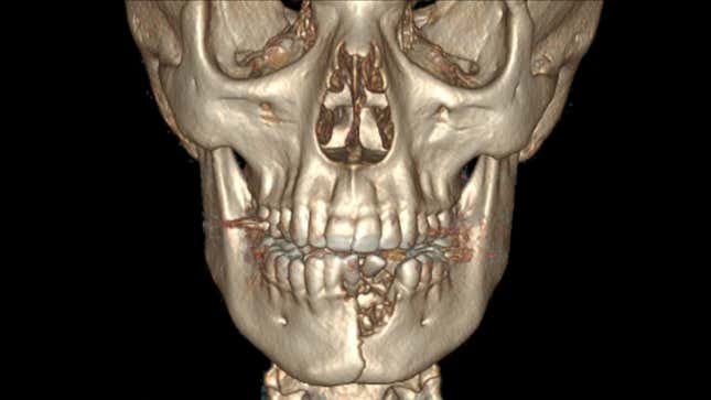 A computed tomography scan showing the lateral jaw fracture, bone loss, and missing teeth.