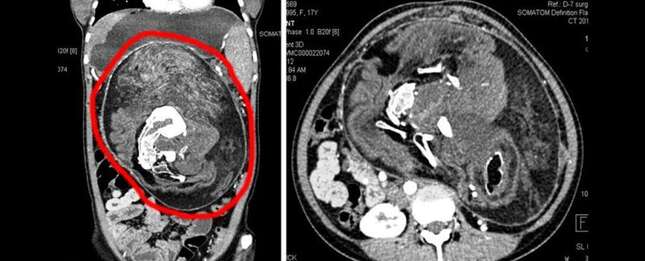 Imagen para el artículo titulado Acude a urgencias por un fuerte dolor de estómago y le encuentran los restos de su gemelo parcialmente formado