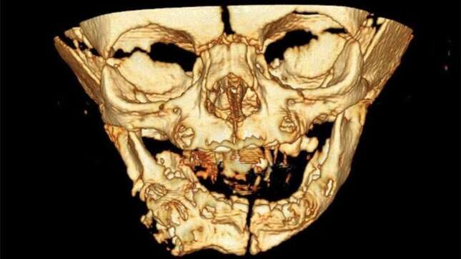 Una niña nace con una segunda boca, una extraña condición de la literatura médica