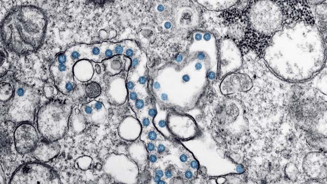 SARS-CoV-2 particles in a human patient, seen in blue.