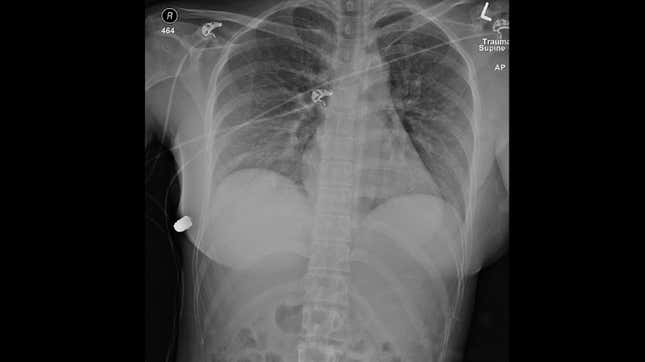Chest radiographs. Bullet is visible at center left.