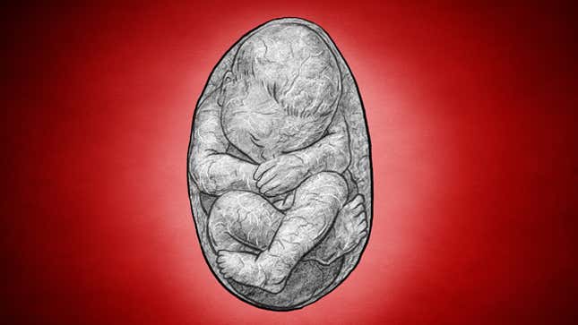 Image for article titled A History of Lithopedions: When a Fetus Turns to Stone