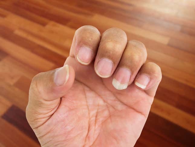 Image for article titled Fingernail Got Fucking Huge Out Of Nowhere