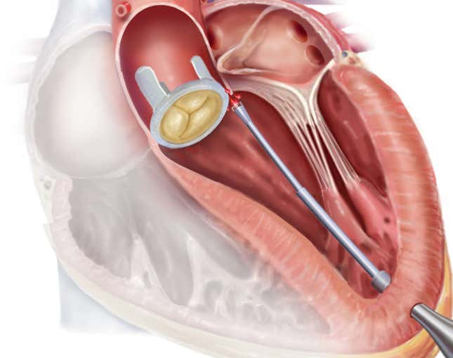 Illustration of robotic catheter navigation to the site of the leaking prosthetic valve.