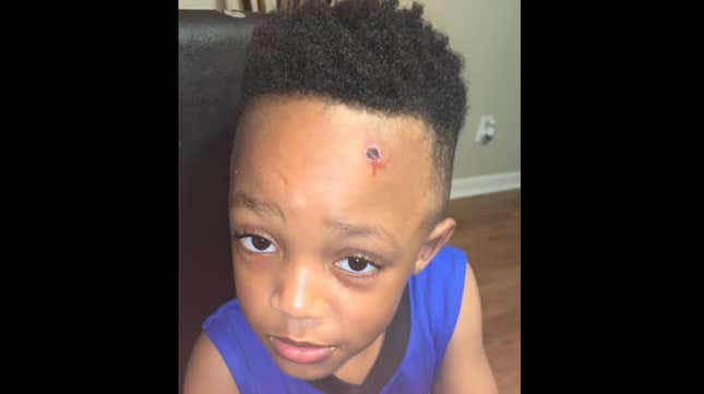 Image for article titled Alabama School Apologizes After Teacher Paints Fake Bullet Wound on Black Student’s Forehead