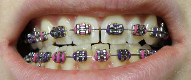 Imagen para el artículo titulado La razón por la que los aparatos para los dientes son de metal