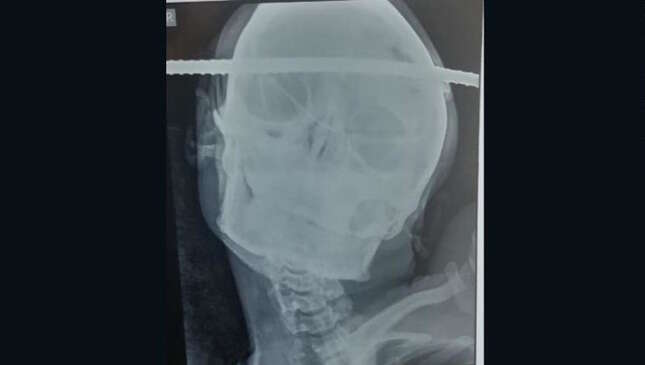 Imagen para el artículo titulado Sobrevive milagrosamente después de que una barra de hierro le atravesara el cráneo de lado a lado