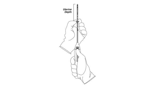 Image for article titled 'What Do You Mean, It Jammed': A Harrowing Journey to IUD City