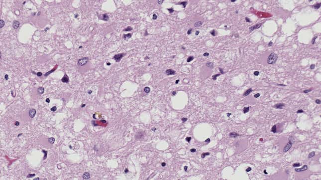 An image of a human brain tissue specimen under a microscope. It displays the telltale spongy holes caused by Creutzfeldt-Jakob disease.