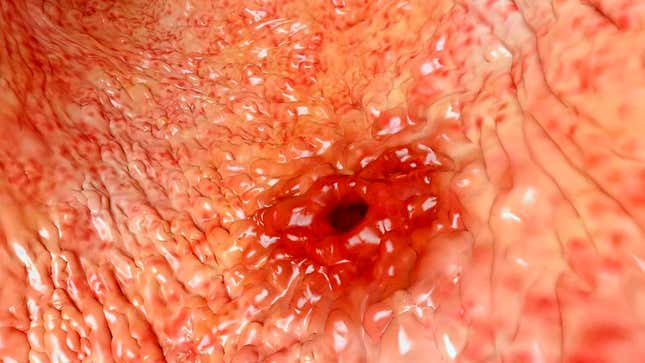 Image for article titled Nation’s Stomach Ulcers Predict Trump Administration Will Provide Opportunities For Unlimited Growth In 2017