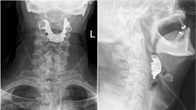 Captura de rayos-X del paciente.
Foto: Harriet A Cunniffe (BMJ)