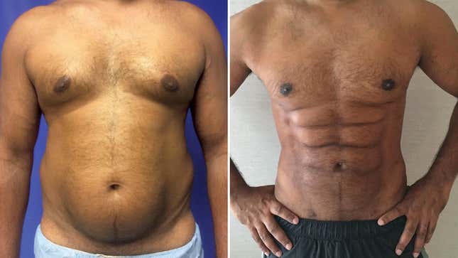 Preoperative frontal view (left) compared to image obtained 1-year postoperatively of a male patient with abdominal etching plus concomitant gynecomastia correction and deltoid/biceps augmentation (right).