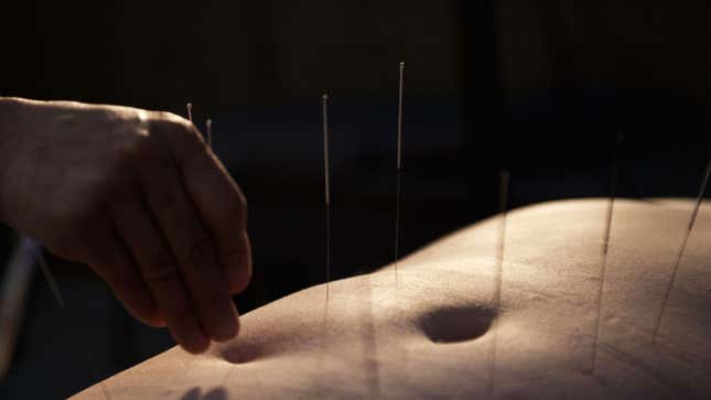 Image for article titled Acupuncturist Went Too Deep, Punctured Patient&#39;s Lungs