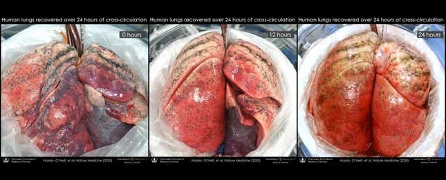 Imagen para el artículo titulado Logran reparar pulmones humanos dañados al conectarlos a cerdos vivos