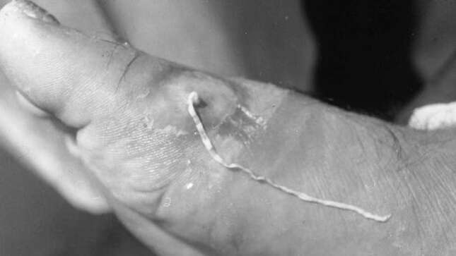 Un extraño parásito casi extinto que vive dentro del cuerpo humano podría haber resurgido en Vietnam