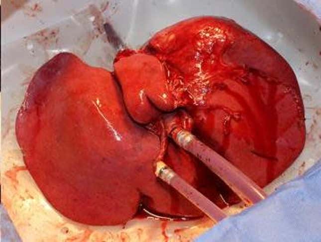 A liver hooked up to the perfusion machine.