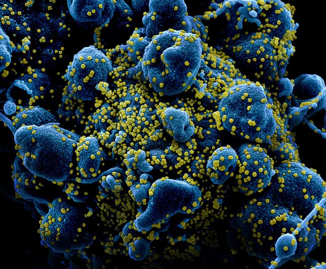 Coronavirus SARS-CoV-2 atacando una célula bajo el microscopio electrónico.