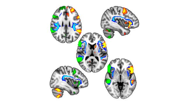Regions of the brain influenced by handedness.