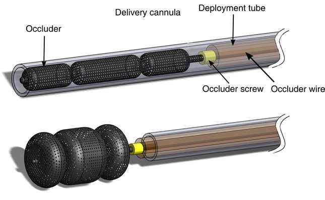 A diagram of the occluder deployment system.