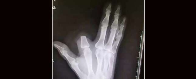 Imagen para el artículo titulado Se corta el dedo tras la mordedura de una serpiente. Los médicos le explican que no era necesario