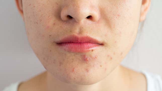 Image for article titled Scientists Still Don&#39;t Really Know What Causes Acne