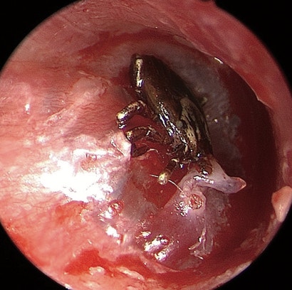 Buzzing In Ear >> Strange Buzzing In 9-Year-Old Boy's Ear Was Actually A Tick Embedded In His Eardrum | Gizmodo ... Buzzing In Ear >> Strange Buzzing In 9-Year-Old Boy's Ear Was Actually A Tick Embedded In His Eardrum | Gizmodo ...