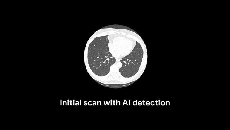 Google Researchers Trained An Algorithm To Detect Lung Cancer Better Than Radiologists Ttpwebmiiclu3be6j6zj