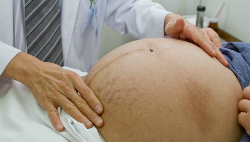 Pregnant Women Everywhere Are Being Bullied Into Having C Sections