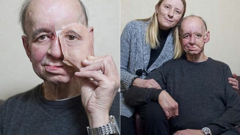 How 3d Printing Gave This Man His Life And Face Back