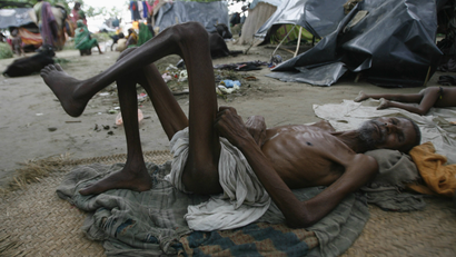 India-malnourished-hunger