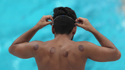 Cupping, K-tape and cryotherapy are a few alternative therapies commonly used by athletes.