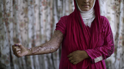 In this May 26, 2012, photo, Pakistani survivor Sajda Ansar, 26, who was set on fire by her husband, shows her burnt arm, at the Acid Survivors Foundation (ASF), in Islamabad, Pakistan. Sajda was set on fire by by her husband in April 2011, following an argument regarding his drug addiction.