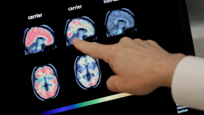 an image of a scientist pointing at brains with Alzheimer's.