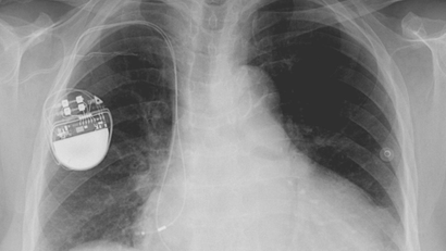 An x-ray image showing a pacemaker implanted in a person's chest.