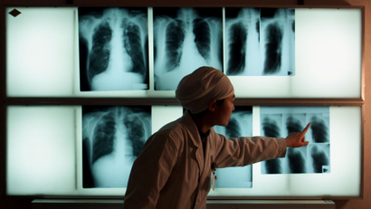 A doctor looks at chest x-rays