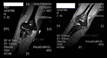 Two MRIs of a UCL tear patient, before and after stem cell therapy treatment